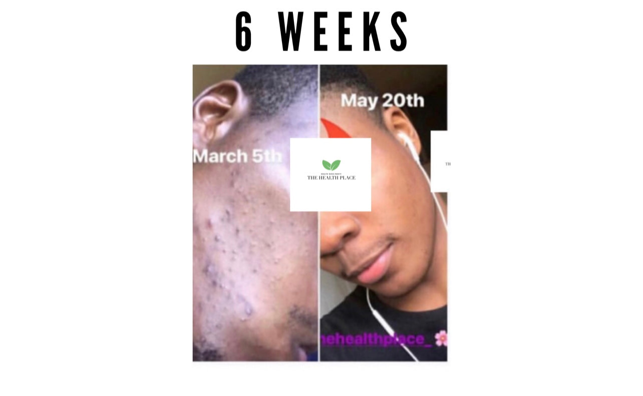 Skin Detox Acne Cleanse Herbal Mix - Choose Form