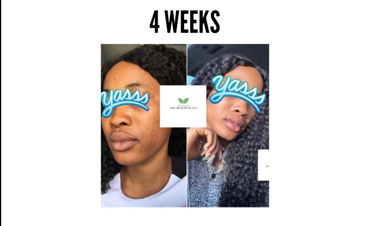 Skin Detox Acne Cleanse Herbal Mix - Choose Form