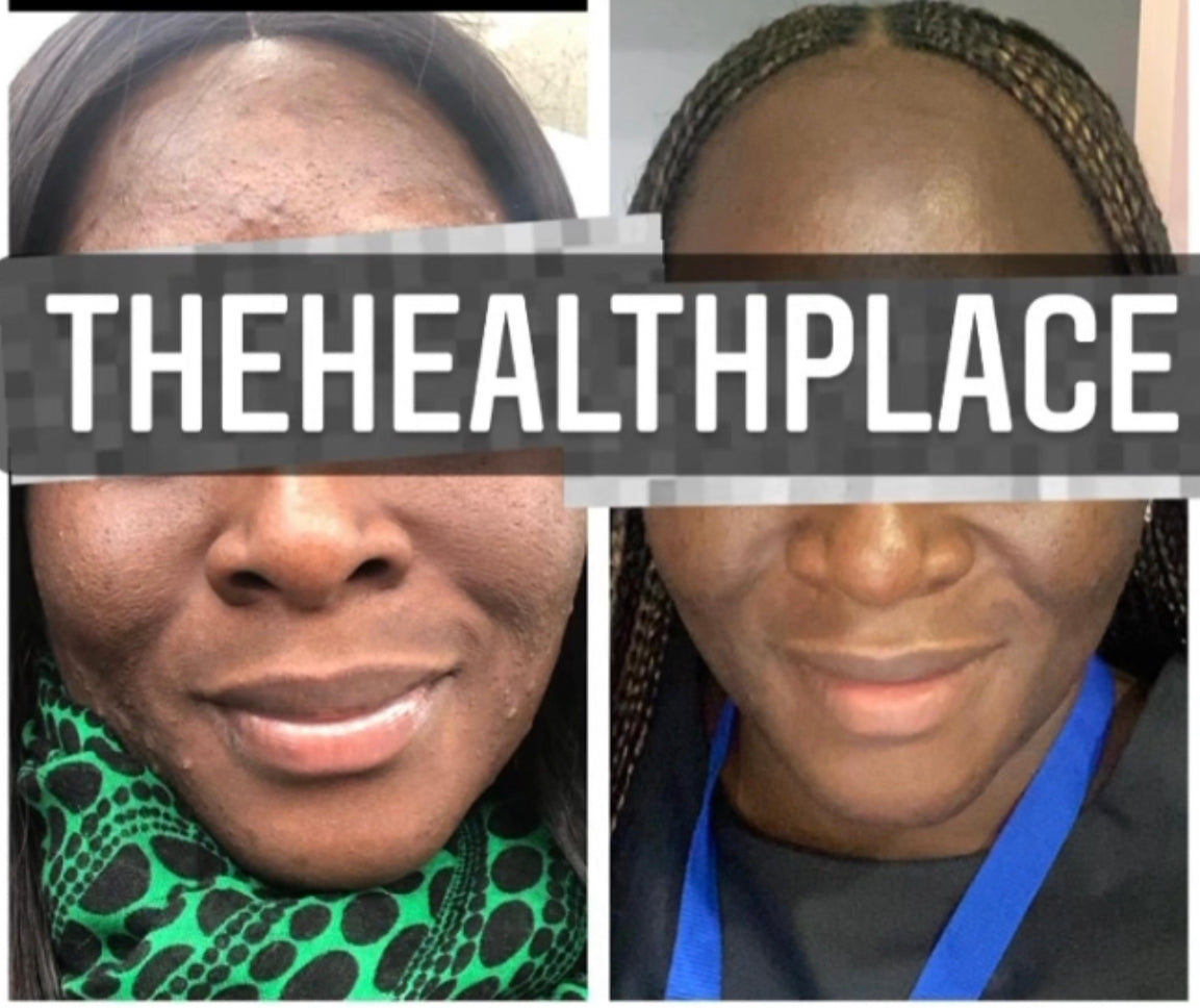 Skin Detox Acne Cleanse Herbal Mix - Choose Form