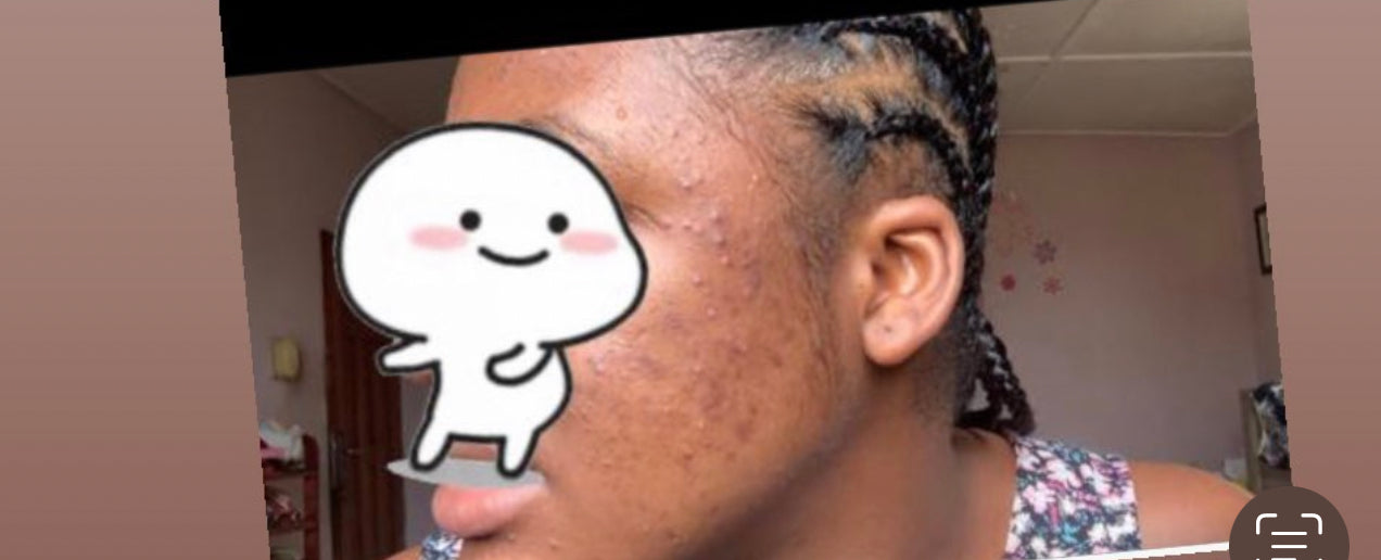 Skin Detox Acne Cleanse Herbal Mix - Choose Form