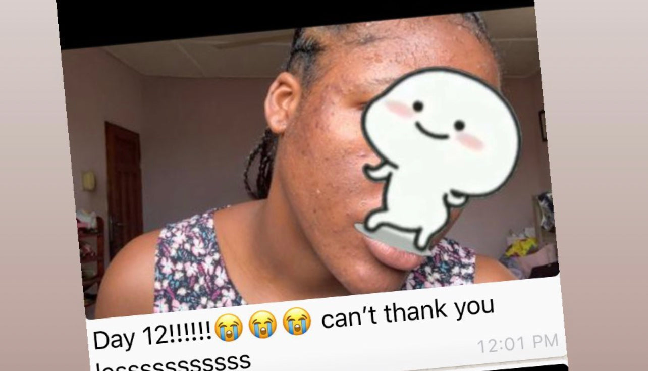 Skin Detox Acne Cleanse Herbal Mix - Choose Form