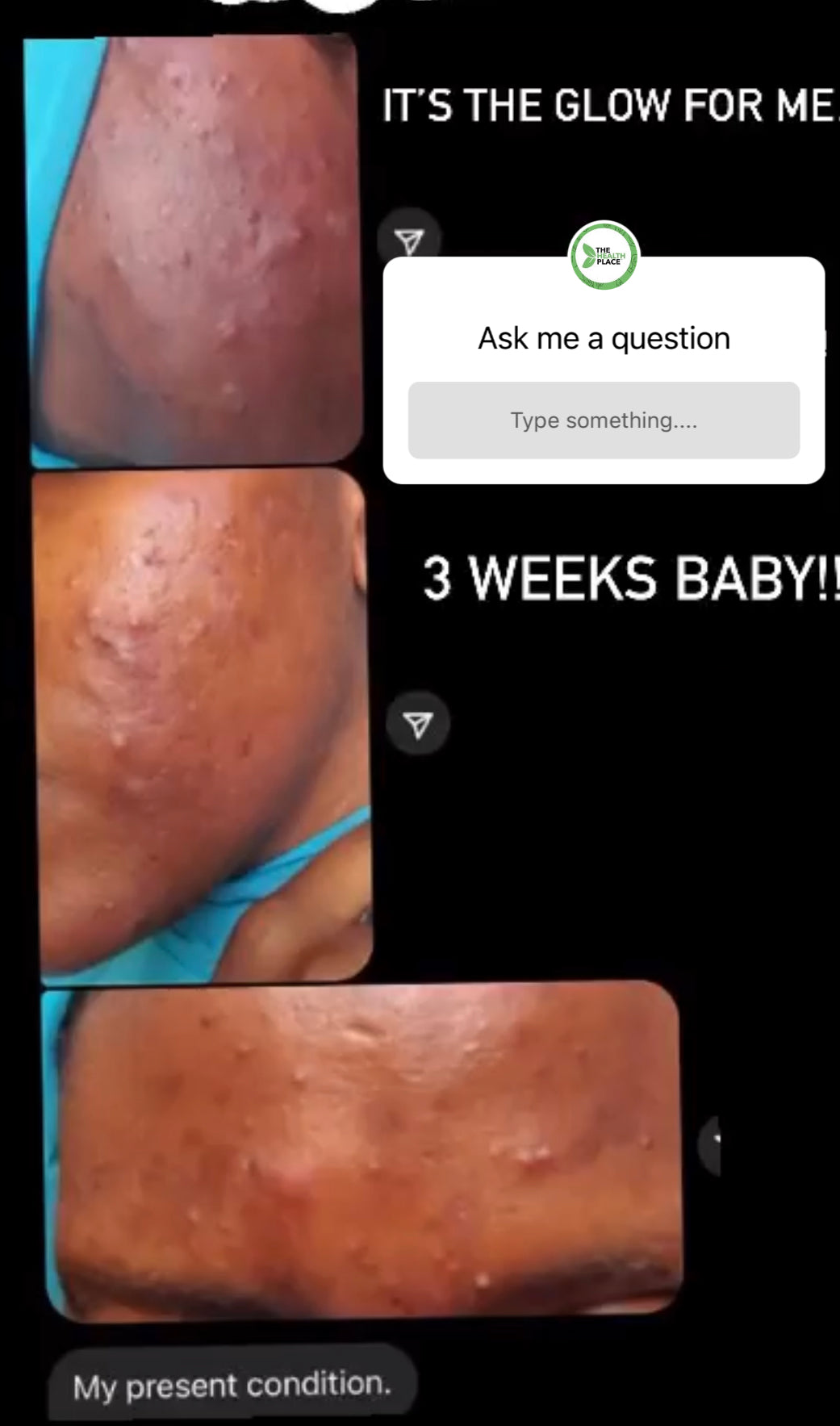 Skin Detox Acne Cleanse Herbal Mix - Choose Form