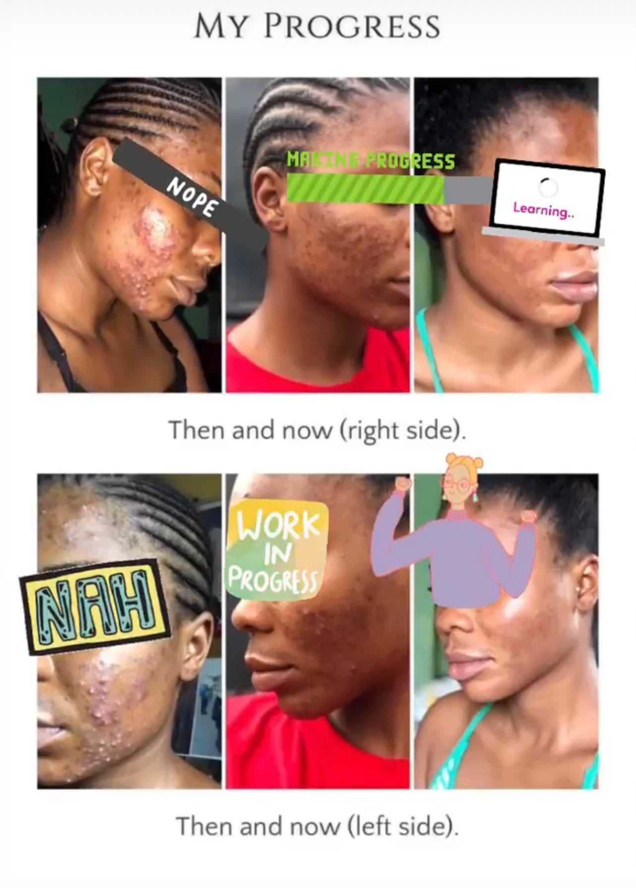 Skin Detox Acne Cleanse Herbal Mix - Choose Form